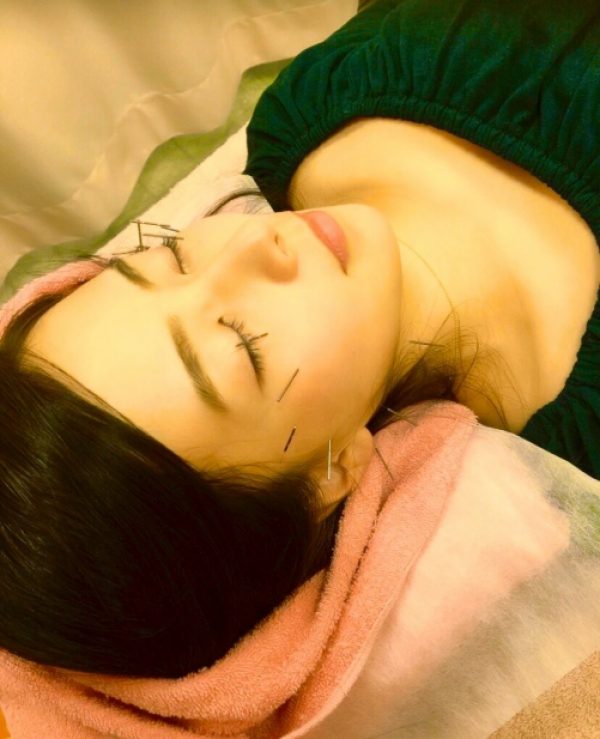 世田谷区千歳烏山で美容鍼・美容鍼灸はオリンピア鍼灸整骨院サムネイル
